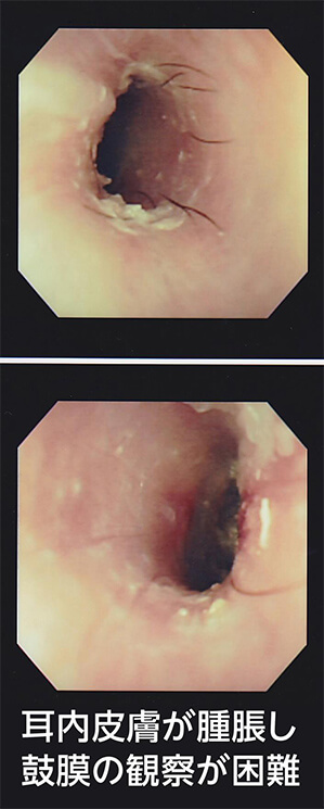 急性・慢性外耳炎